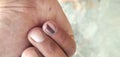 Black line on nails. Subungual melanoma.