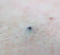 Black pimple acne on human skin, background. Acne and acne treatment, cosmetology, hygiene