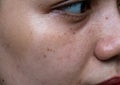 Black spots, moles and scars on the face of Asian woman