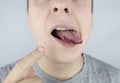 Black tongue. A man shows the consequences of an injury, bite or burn of the tongue. Part is damaged. Treatment of internal