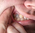 Black tooth in the mouth of a man after nerve depulpation. Dead darkened tooth, macro Royalty Free Stock Photo