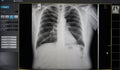 Black and white body , rib , lung , heart , film X-ray