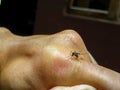 Mosquito sucking blood on human knuckle