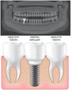 Black and white x-ray of jaw above human gum with normal healthy teeth and dental implant Royalty Free Stock Photo