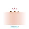 Blackhead acne vector illustration isolated on white background.