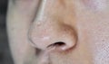 Blackheads or black heads on nose of Asian man