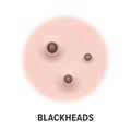 Blackheads skin acne type vector icon. Skin disease acne blackheads pimples type, face pore comedones