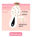 Blackheads are small bumps that appear on skin due to clogged pores. Skin care concept