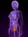 Bladder cancer