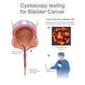 Bladder cancer is any of several types of cancer arising from th