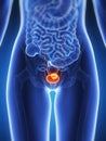 Bladder cancer