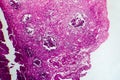 Bladder cancer, light micrograph Royalty Free Stock Photo