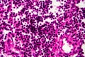 Bladder cancer, light micrograph Royalty Free Stock Photo