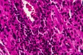 Bladder cancer, light micrograph