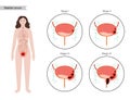 Bladder cancer stages