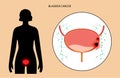 Bladder cancer stages