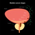 Bladder cancer stages