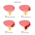 Bladder cancer stages