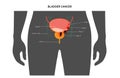 Bladder cancer stages