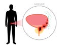 Bladder cancer stages