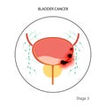 Bladder cancer stages