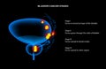 Bladder cancer stages