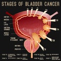 Bladder cancer stages