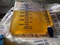 Bladder catheter reservoir filled with yellow urine