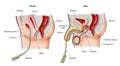 Bladder catheters in-situ