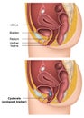 Bladder Cystocele with description medical  illustration Royalty Free Stock Photo