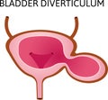 A bladder diverticulum is a pouch in the bladder wall. Two similar cavities. outpouching of a hollow structure in the