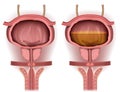 Bladder empty and filled with urine 3d medical illustration