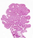 Bladder polyp