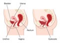 Bladder prolapse