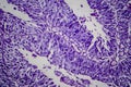 Bladder transitional cell carcinoma, light micrograph Royalty Free Stock Photo