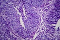 Bladder transitional cell carcinoma, light micrograph Royalty Free Stock Photo