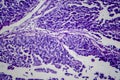 Bladder transitional cell carcinoma, light micrograph Royalty Free Stock Photo