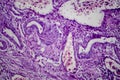 Bladder transitional cell carcinoma, light micrograph Royalty Free Stock Photo