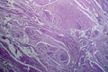 Bladder transitional cell carcinoma, light micrograph Royalty Free Stock Photo