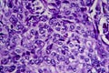 Bladder transitional cell carcinoma, light micrograph Royalty Free Stock Photo