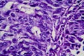 Bladder transitional cell carcinoma, light micrograph Royalty Free Stock Photo