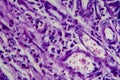 Bladder transitional cell carcinoma, light micrograph