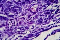 Bladder transitional cell carcinoma, light micrograph Royalty Free Stock Photo