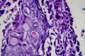 Bladder transitional cell carcinoma, light micrograph Royalty Free Stock Photo