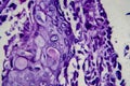 Bladder transitional cell carcinoma, light micrograph