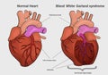 Bland White Garland syndrome versus normal heart anatomy