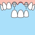 Blank banner Bridges teeth upper implant illustration vector on blue background. Dental concept