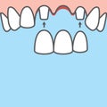 Blank banner Bridges teeth upper original root illustration vector on blue background. Dental concept