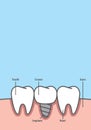 Blank banner Implant tooth between real teeth frame cartoon style for info or book illustration vector on blue background. Dental