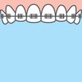 Blank banner Upper Braces teeth illustration vector on blue background. Dental concept